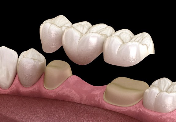 3D render of a dental crown