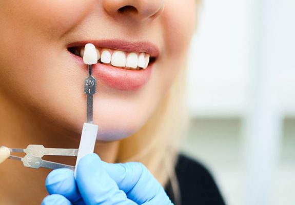 Woman's smile compared with tooth shade chart