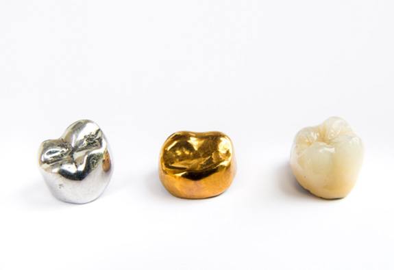 Three dental crowns made of various materials