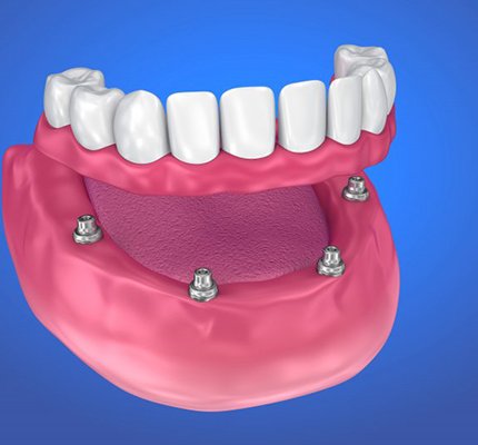 illustration of an implant denture on the lower arch