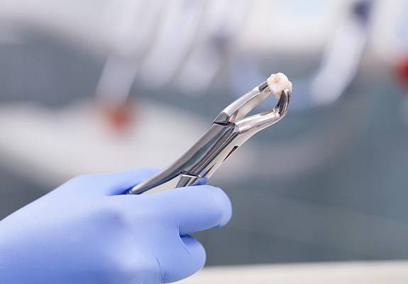 Holding an extracted tooth in forceps after tooth extraction in Fanwood, NJ