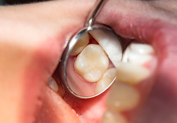 Tooth-colored fillings