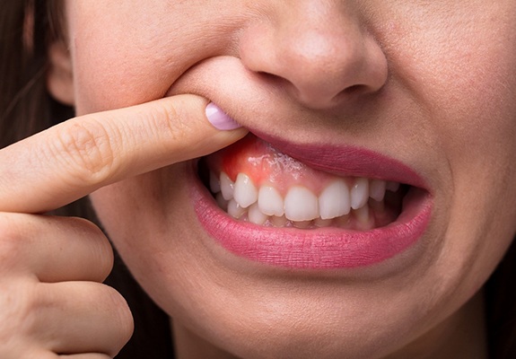 Close-up of woman showing red gums