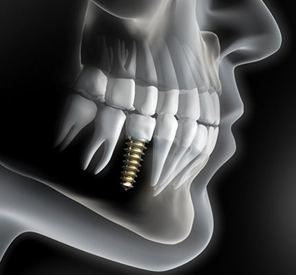 A diagram of an integrated dental implant