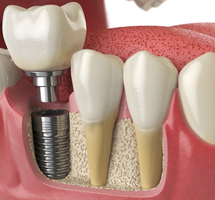 A diagram of a dental implant model