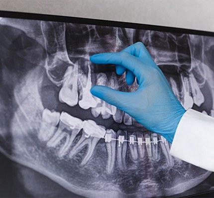 A dentist placing their hand on a dental X-ray