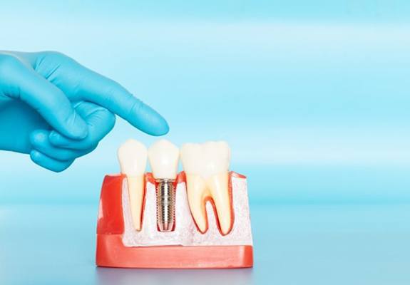 A dentist pointing at a model of a dental implant.