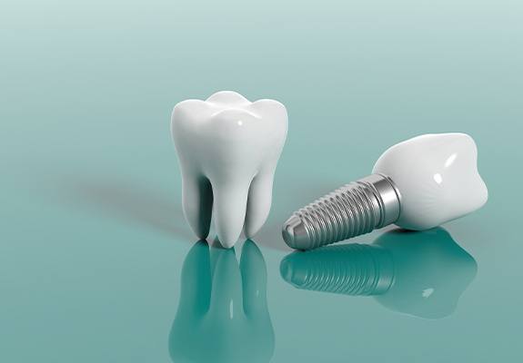 A diagram of a tooth and a dental implant