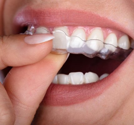 close-up of a person putting an Invisalign tray in their mouth 