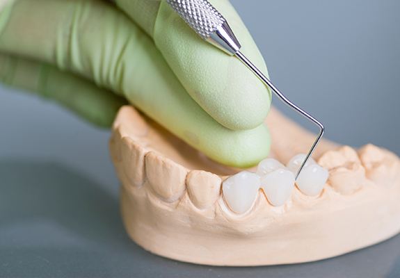 Model smile with dental bridge restoration