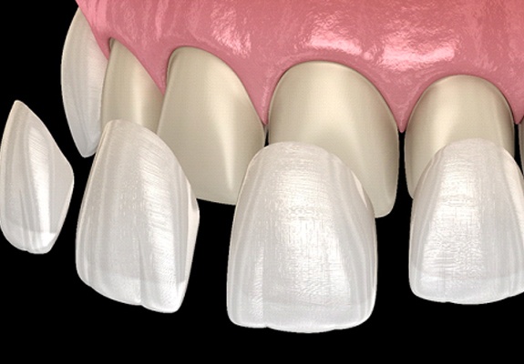 Diagram of several veneers being placed