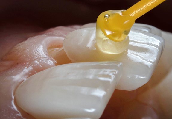 dentist placing a porcelain veneers on a prepared tooth