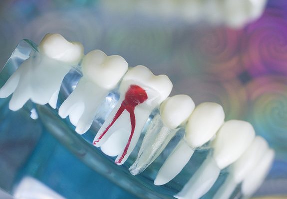 model of a mouth with an infected tooth