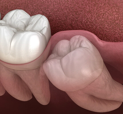close-up of an impacted wisdom tooth