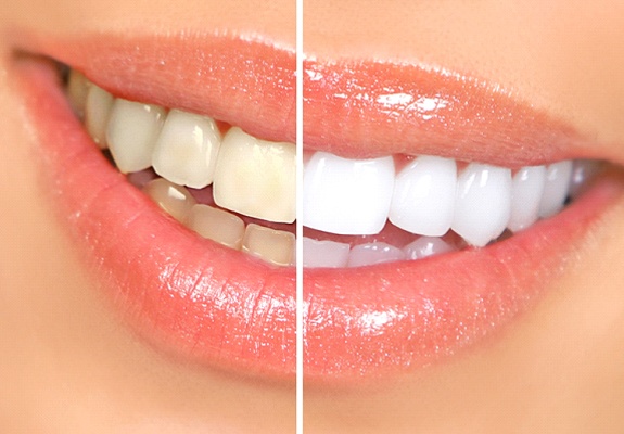 Teeth whitening