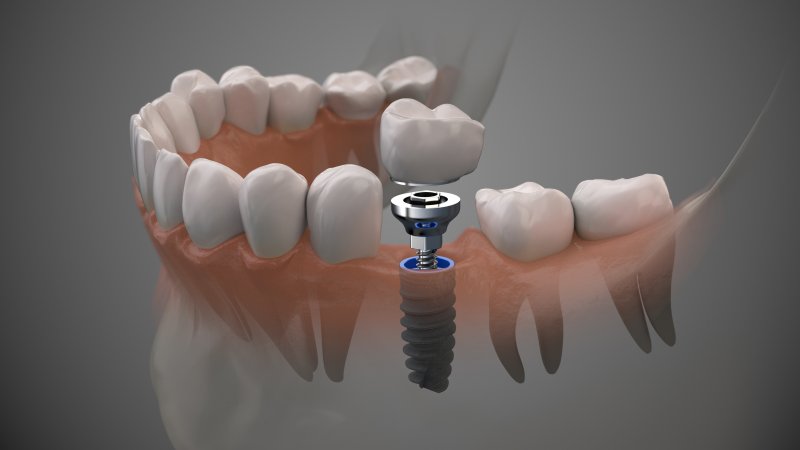 3-D render of a dental implant
