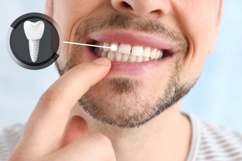 A man showing off his dental implants