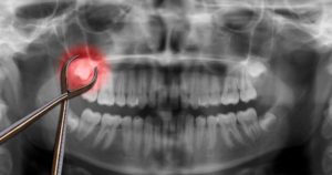 Forceps over wisdom tooth glowing red in an xray